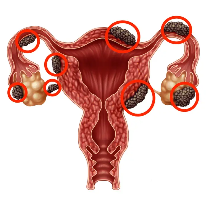 Endometrioza