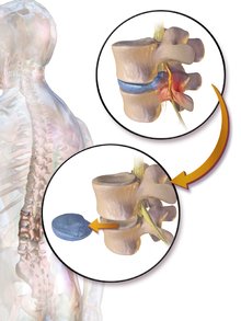 Discektomia