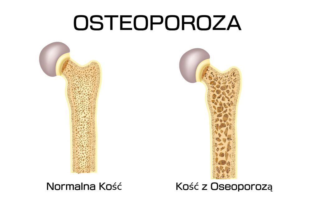 Osteoporoza