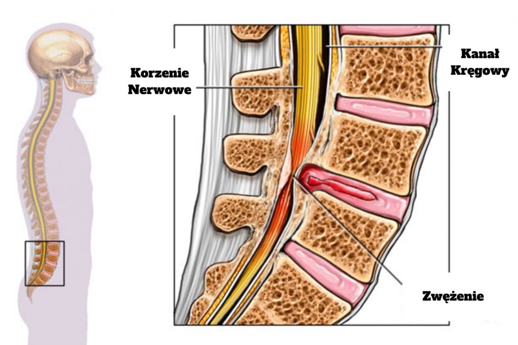Ucisk na nerwy kręgosłupa