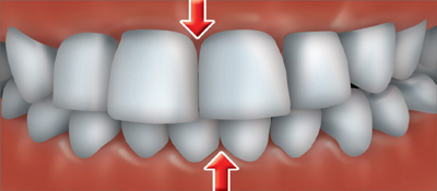 Przemieszczenie Zębów