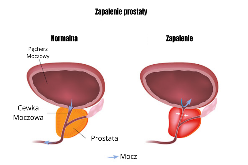 Zapalenie prostaty