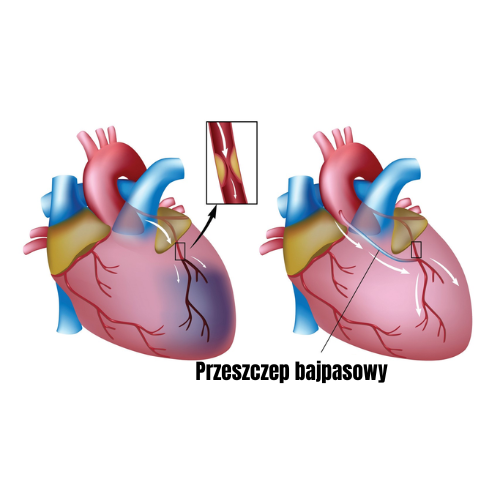 Operacja bajpasów