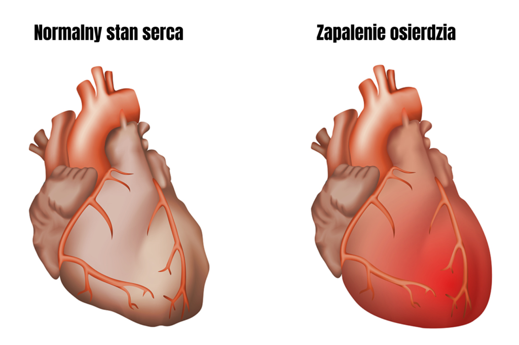 Zapalenie osierdzia