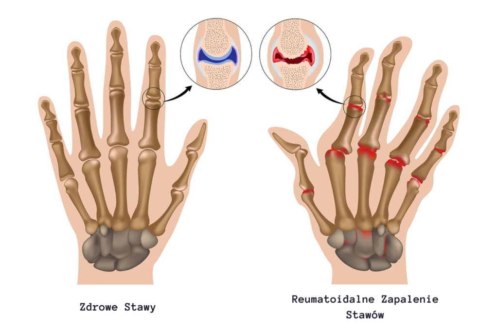 Reumatoidalne Zapalenie Stawów