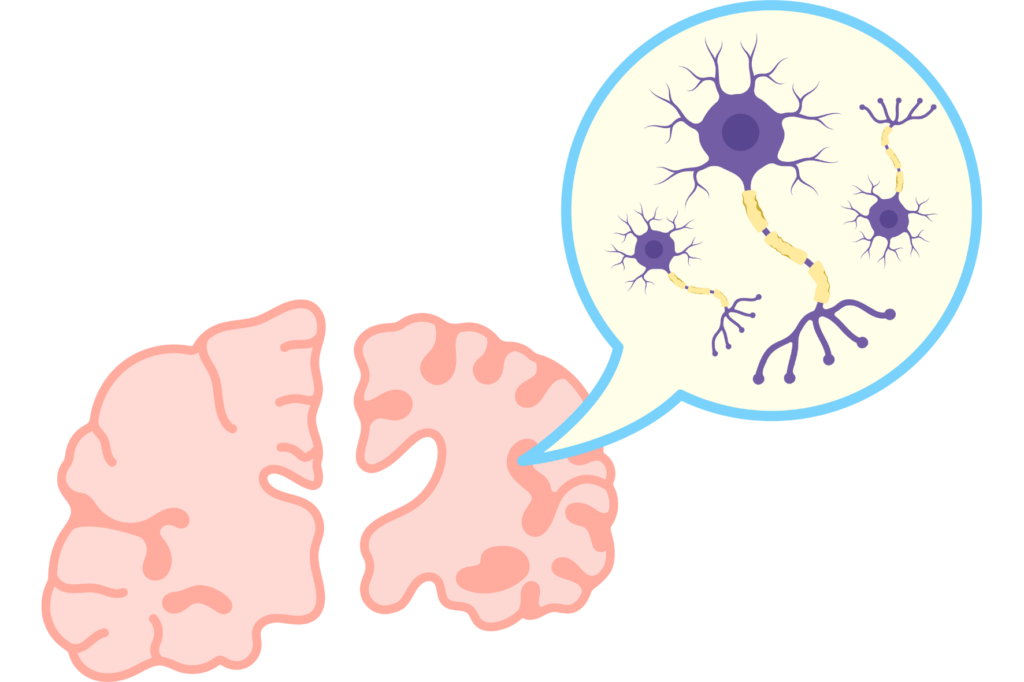 Choroba Alzheimera - neurodegeneracyjne schorzenie