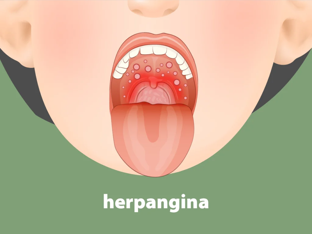 Herpangina