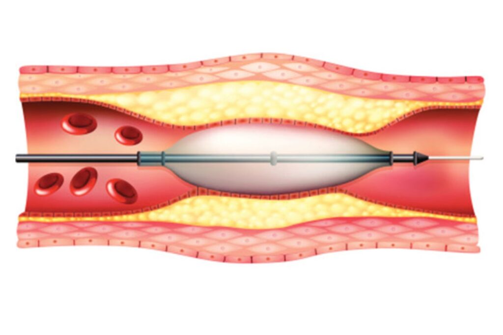 Angioplastyka