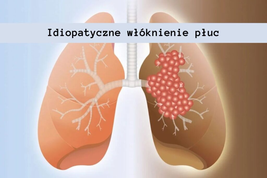 Idiopatyczne włóknienie płuc