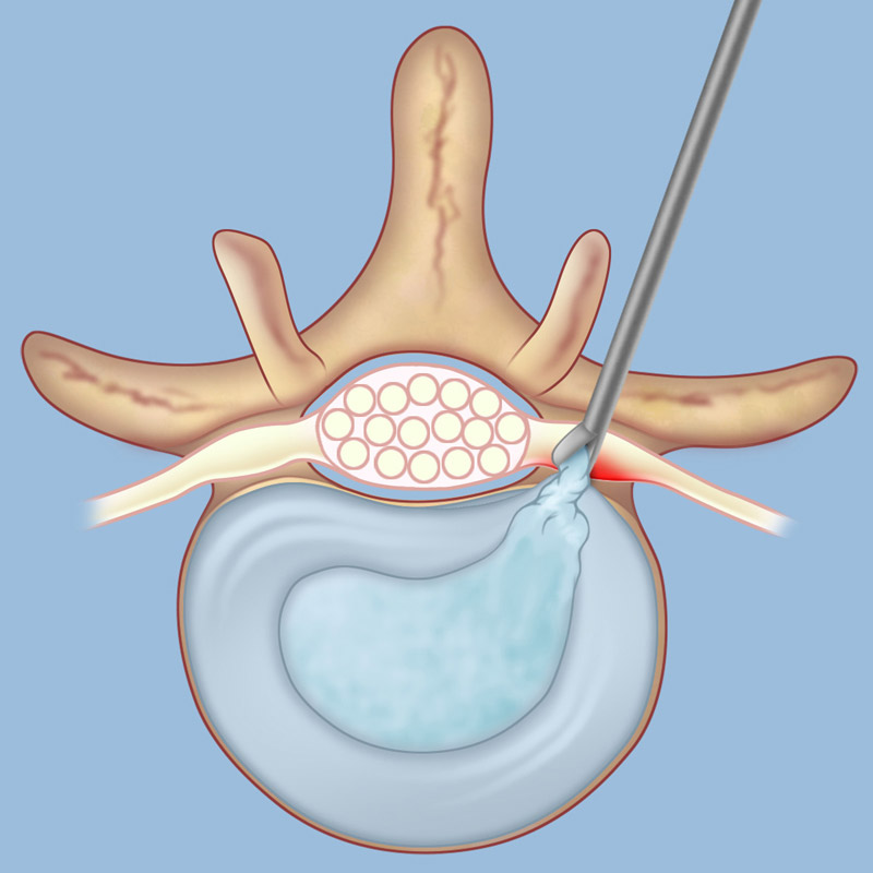 Mikrodyscektomia