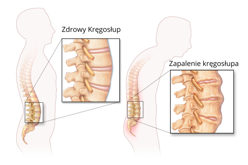 Zapalenie Kręgosłupa