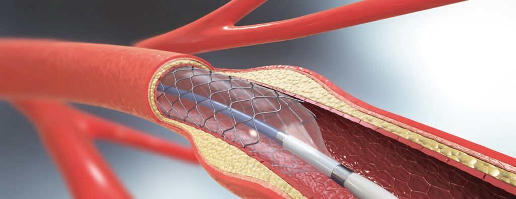 angioplastyka z wszczepieniem stentów