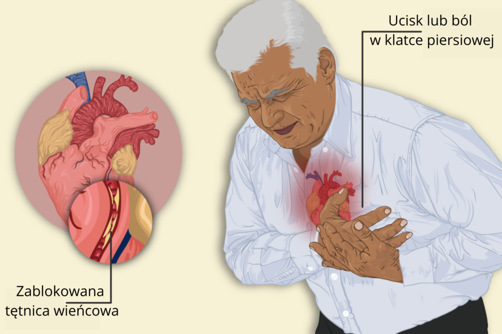 Ból w klatce piersiowej