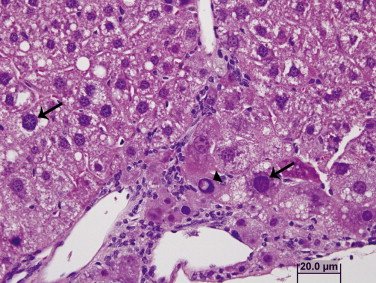 Cytomegalia - wirus