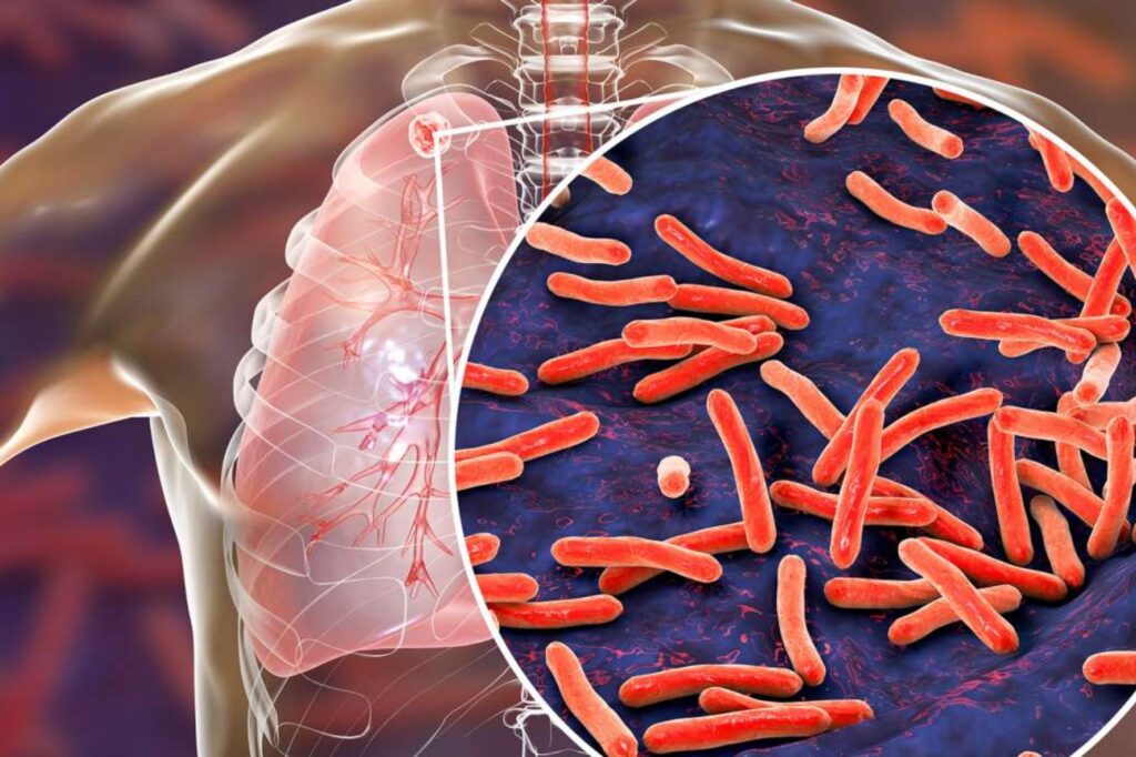 Gruźlica - Mycobacterium tuberculosis