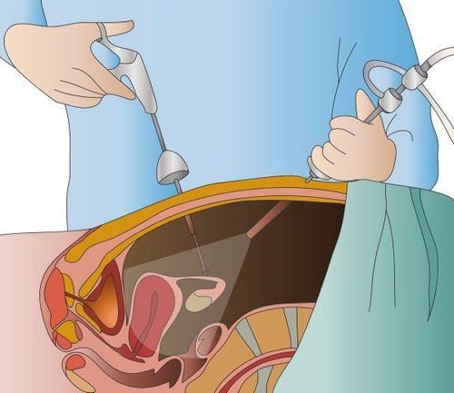 Laparoskopia diagnostyczna