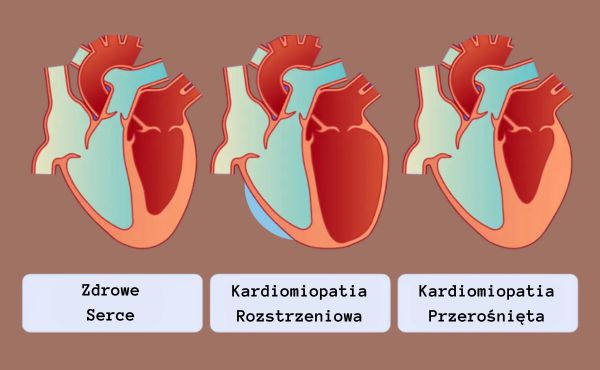 Kardiomiopatia rozstrzeniowa vs. kardiomiopatia przerośnięta (HCM)