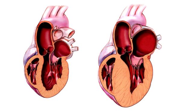 Normalne serce vs Kardiomiopatia przerostowa