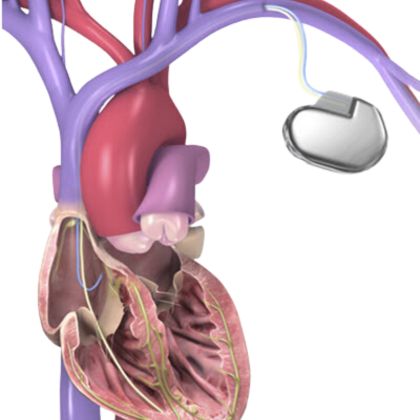 Wszczepialne defibrylatory (ICD) 