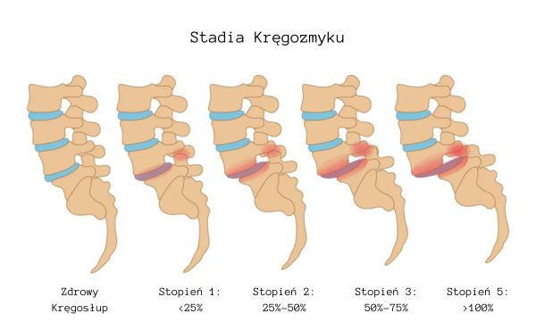 Kręgozmyk zwyrodnieniowy