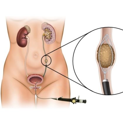 Ureteroskopia