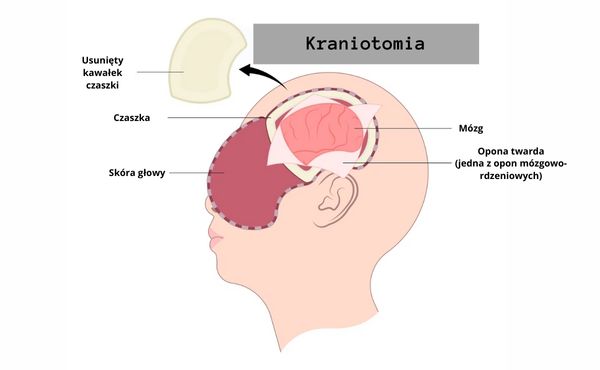 Kraniotomia