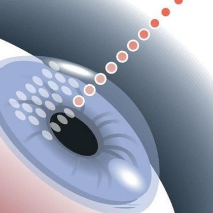 LASIK (Laser-Assisted In Situ Keratomileusis)