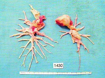 Endarterektomia płucna