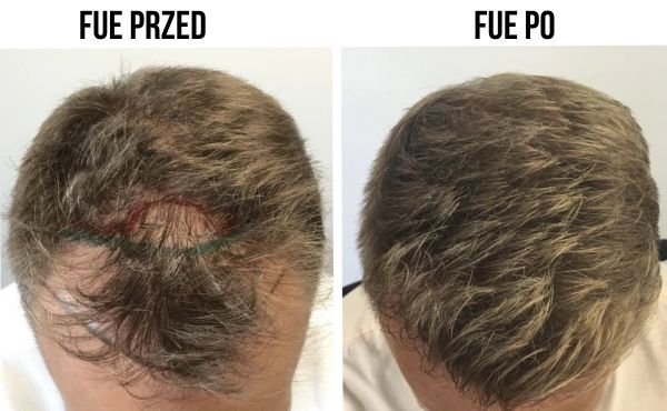 Follicular Unit Extraction