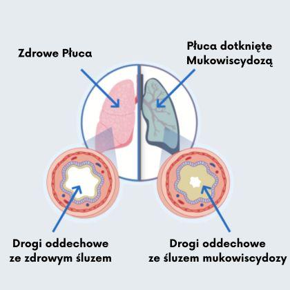 Mukowiscydoza