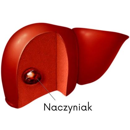 Naczyniak wątroby