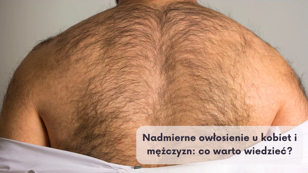 Nadmierne owłosienie u kobiet i mężczyzn: co warto wiedzieć?