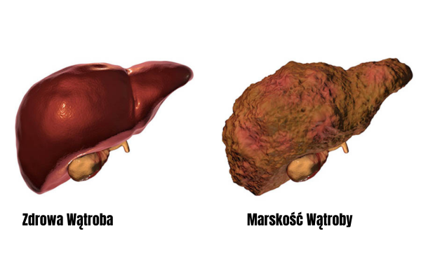 Czym jest Marskość Wątroby