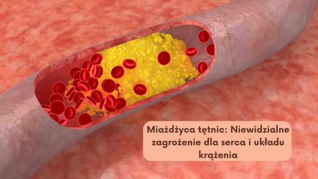 Miażdżyca tętnic: Niewidzialne zagrożenie dla serca i układu krążenia