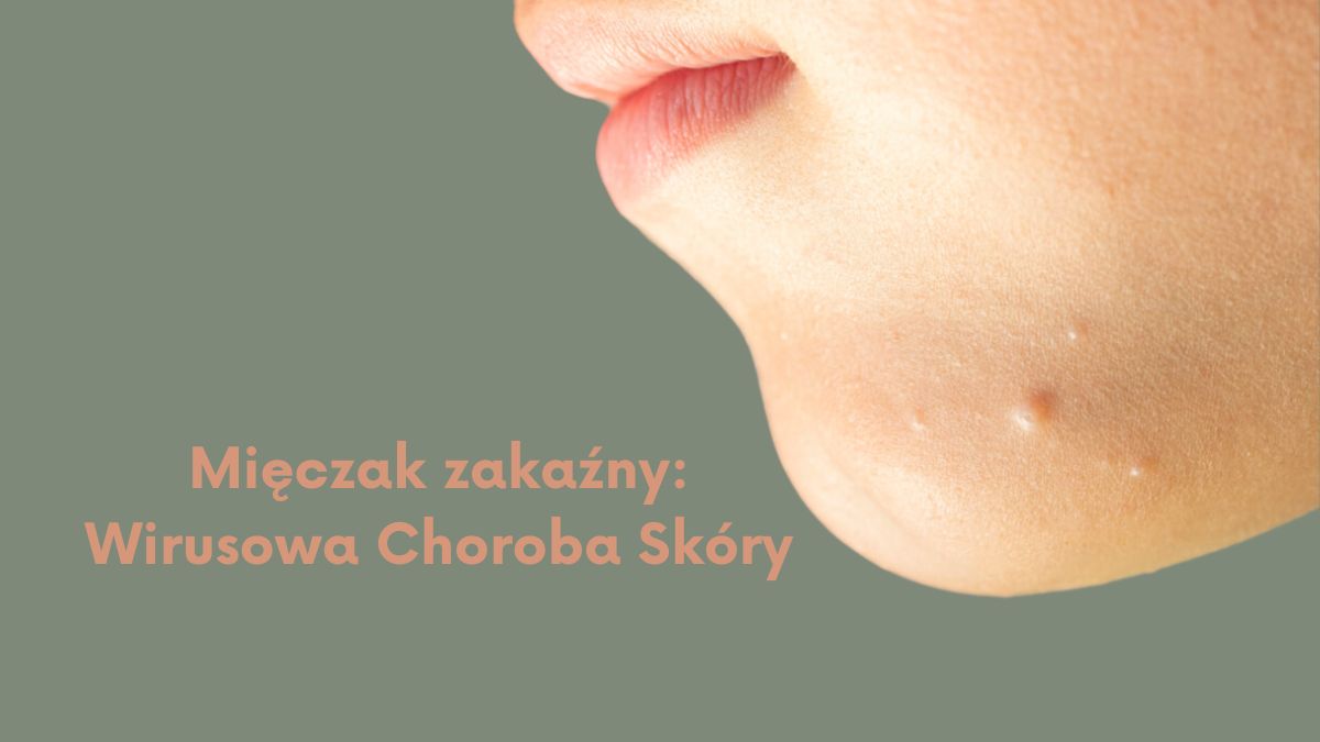 Mięczak zakaźny: Wirusowa Choroba Skóry