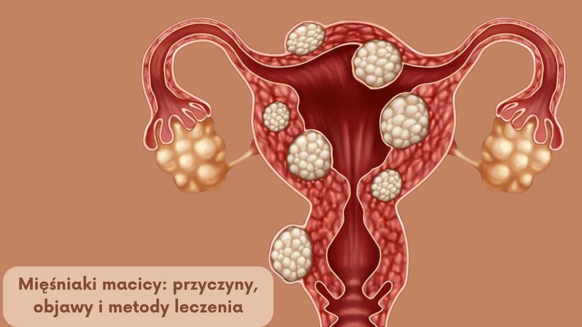 Mięśniaki macicy: przyczyny, objawy i metody leczenia