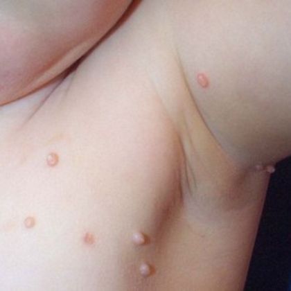 Molluscum contagiosum