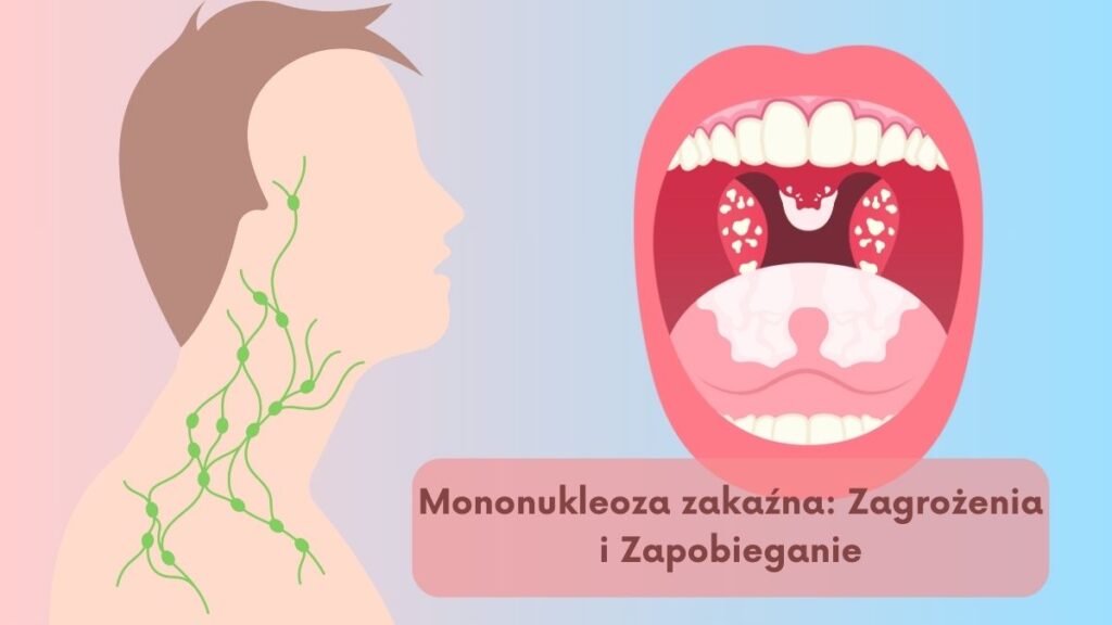 Mononukleoza zakaźna: Zagrożenia i Zapobieganie