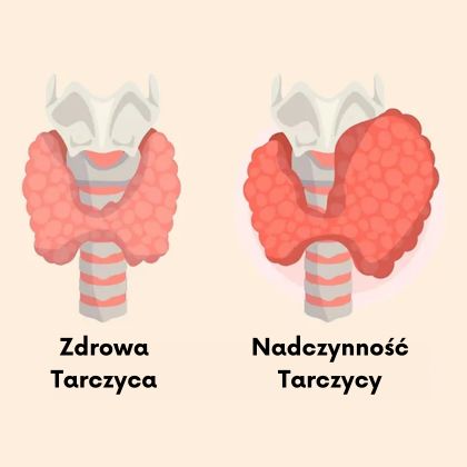 Nadczynność Tarczycy