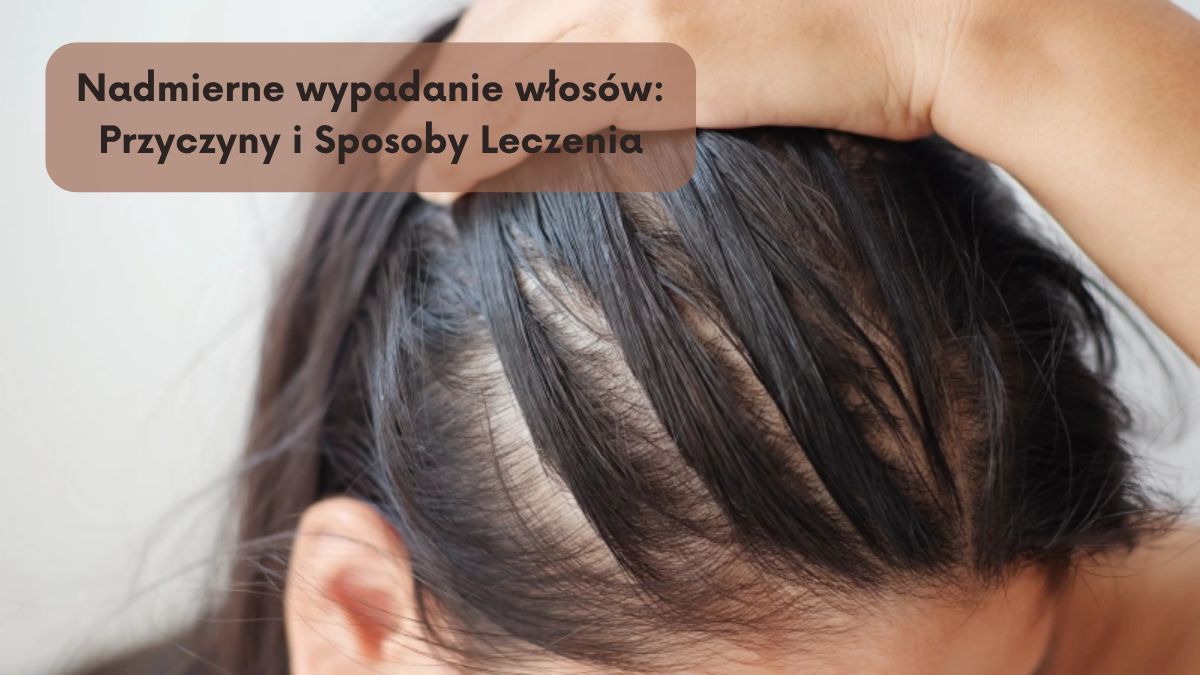 Nadmierne wypadanie włosów: Przyczyny i Sposoby Leczenia