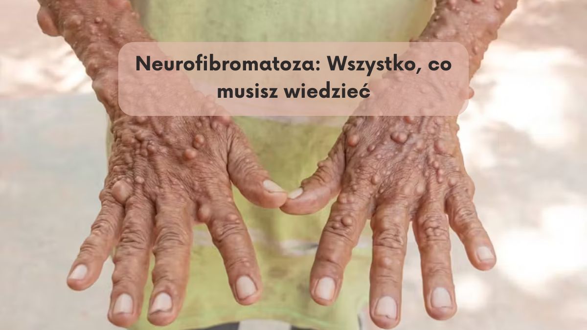 Neurofibromatoza: Wszystko, co musisz wiedzieć