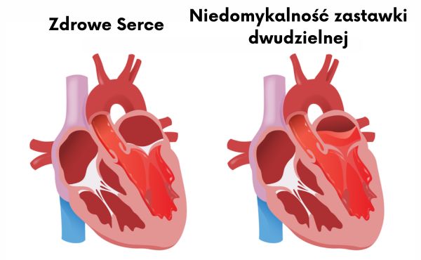 Niedomykalność zastawki dwudzielnej