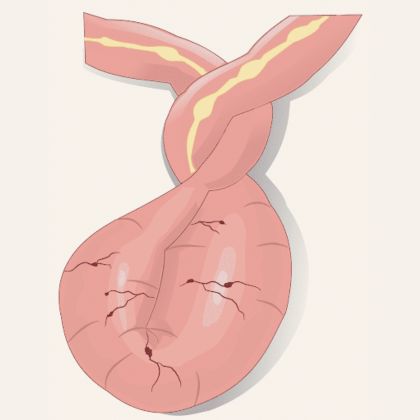 Skręt jelita