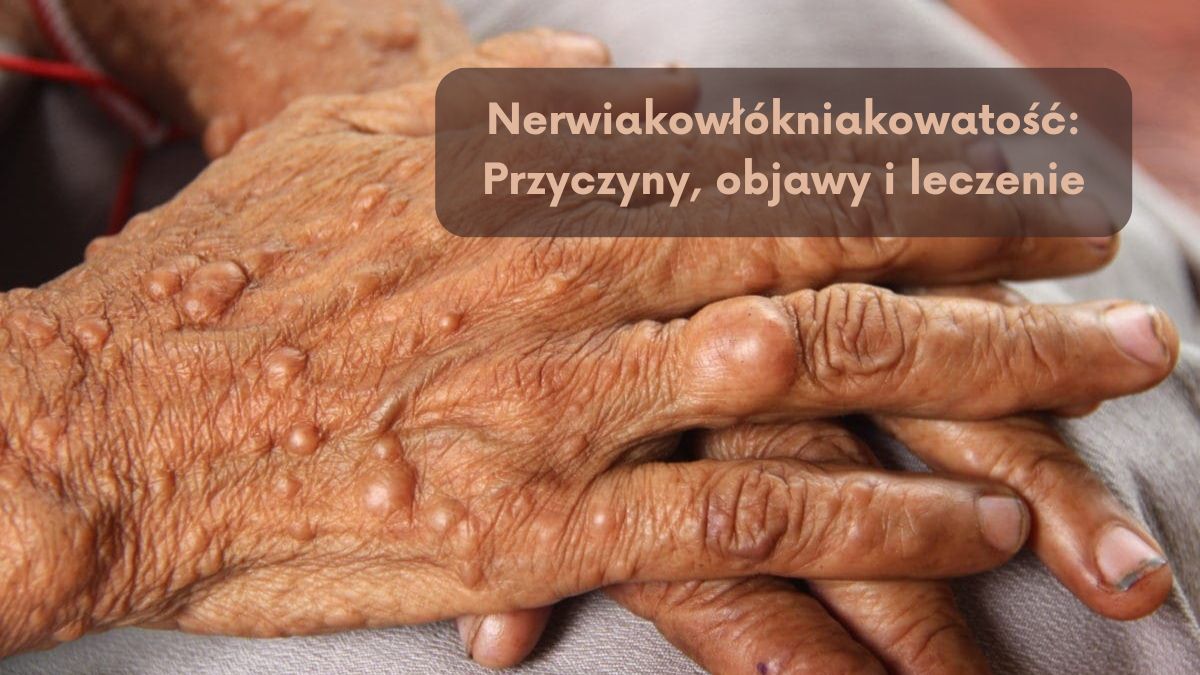 Nerwiakowłókniakowatość: Przyczyny, objawy i leczenie