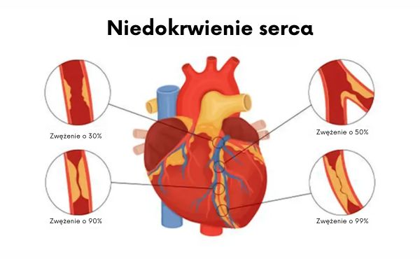 Niedokrwienie serca