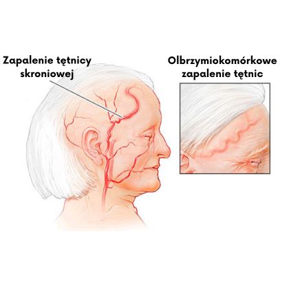 Jak działa olbrzymiokomórkowe zapalenie tętnic?