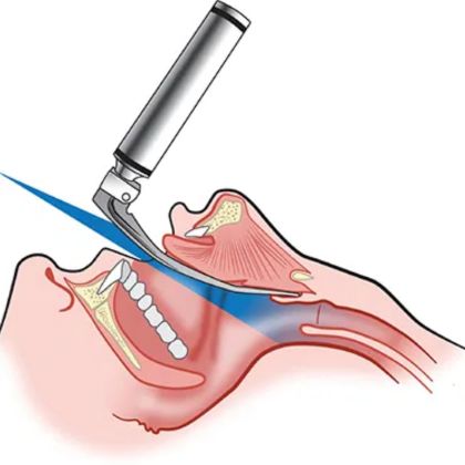 Laryngoskopia