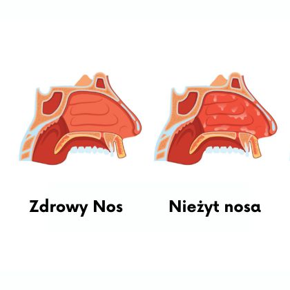 Nieżyt nosa