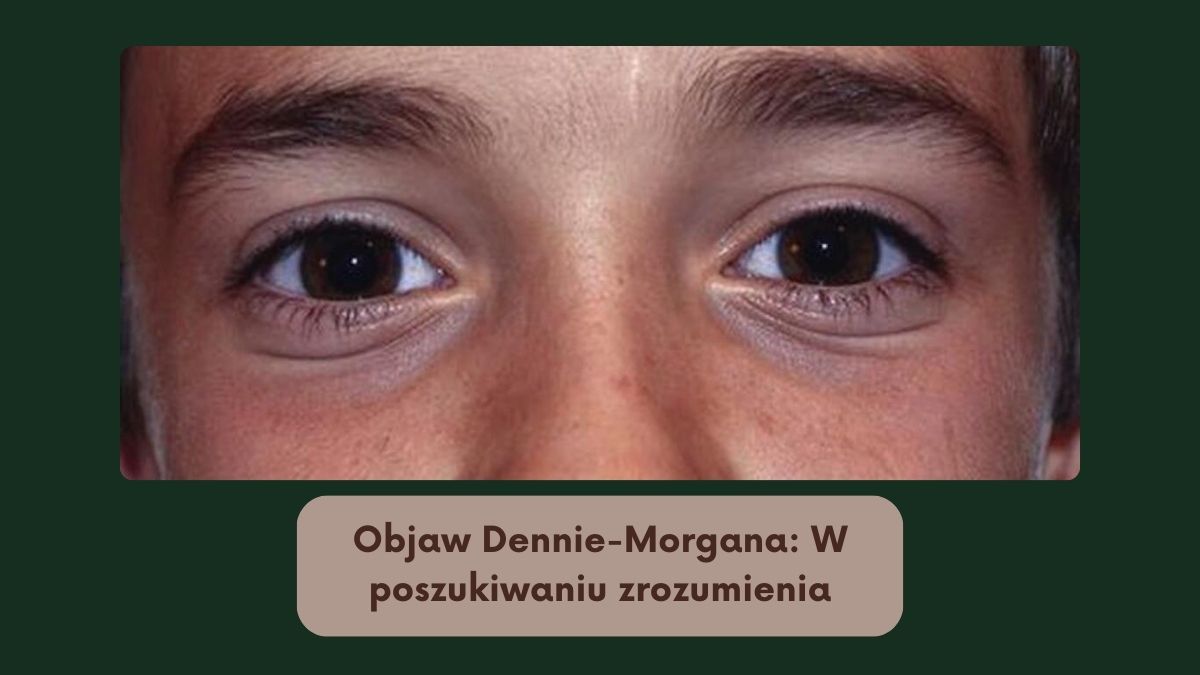 Objaw Dennie-Morgana: W poszukiwaniu zrozumienia