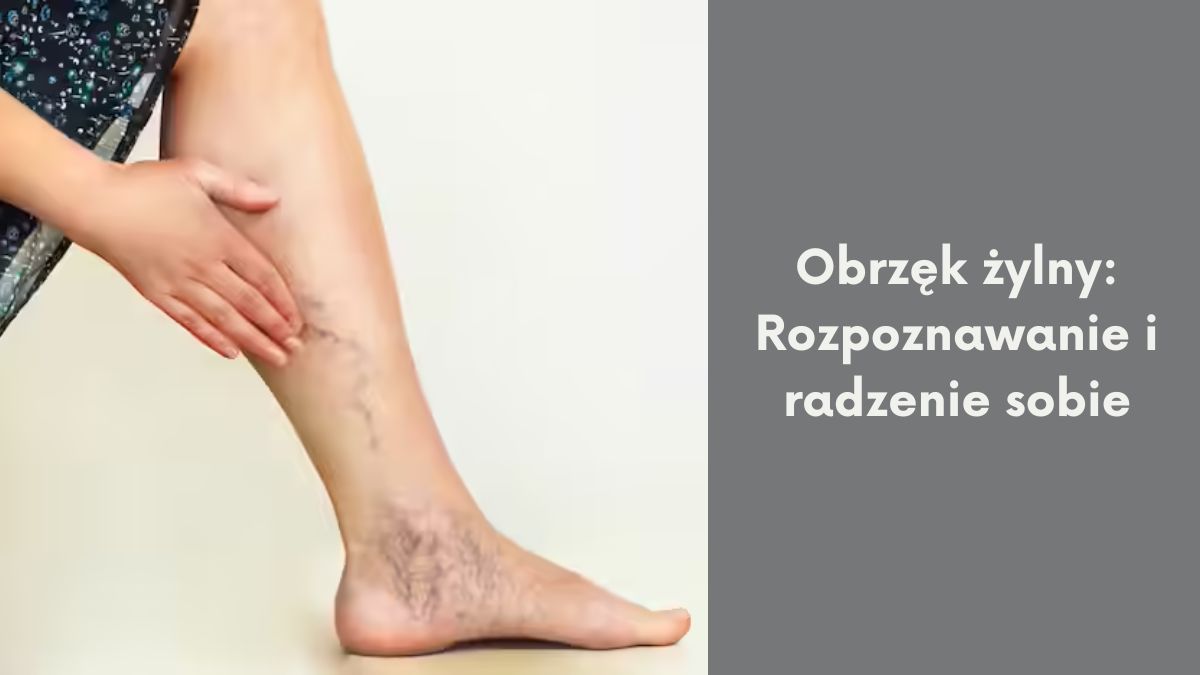 Obrzęk żylny: Rozpoznawanie i radzenie sobie